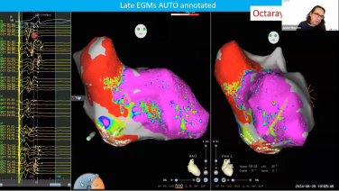 Dr. Moreno and Dr. Dias discuss their procedural workflow for VT