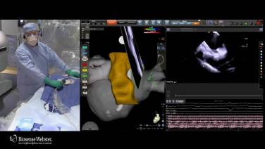 A image of Customized Strategy for Persistent AF with Brian James DeVille, MD