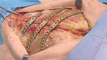 An image of the "Titanium Sternal Fixation System - Surgical Technique Video (CMF)".