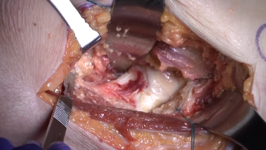 Cutting the Capsule in an Anterior Approach with Tania Ferguson, MD