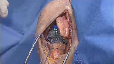 Image of the GLOBAL UNITE™ Platform Shoulder System Reverse Fracture Preformed by Carl Basamania, MD video.