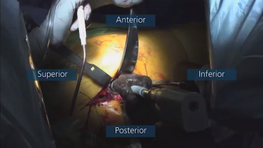 image of "Reaming Technique Demonstration with Matthew Austin, MD" video on jnjinstitute.com