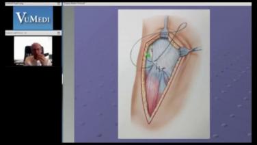 ANTERIOR ADVANTAGE™ Discussion with Joel Matta, MD - Extending the Anterior Approach Incision for Complex Hip Revisions