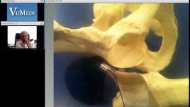 An image of the "AA Discussion with Joel Matta, MD - Retracting a Primary Stem for Anterior Approach Acetabular Hip Revisions" video.