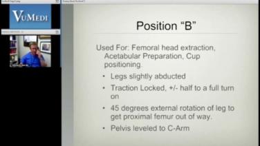 An image of the "AA Discussion with Nick Mast, MD - Manipulating the Hana® table in Anterior Approach Revisions" video.