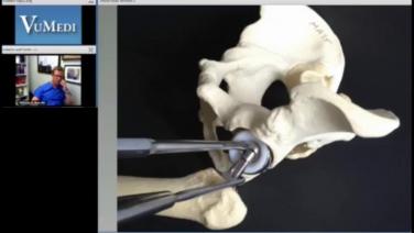 An image of the "AA Discussion with Nick Mast, MD - Removing the Prosthetic Femoral Head in a Anterior Approach Revision" video.