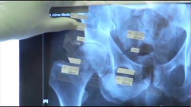 an image of "ANTERIOR ADVANTAGE™ Discussion with Joel Matta, MD - Templating a Dysplastic Hip in an Anterior Approach Procedure" video on jnjinstitute.com