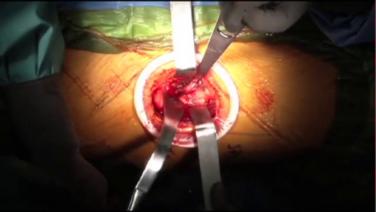 An image of the "ANTERIOR ADVANTAGE™ Discussion with Joel Matta, MD - Releasing Distal Fascia for Anterior Approach Femoral Exposure" video.