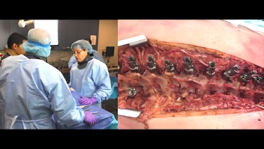 An image from the "Mobilizing the Spine using the EXPEDIUM VERSE® System with Randal Betz, MD, Baron Lonner, MD, and Suken Shah, MD" video on the JnJInstitute.com website.