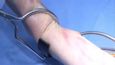 An image of the "Soft Tissue Bone Reduction Forceps - Product Overview" video.