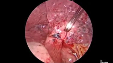 Thorascopic Lobectomy - Dissect Out & Encircle Pulmonary Artery