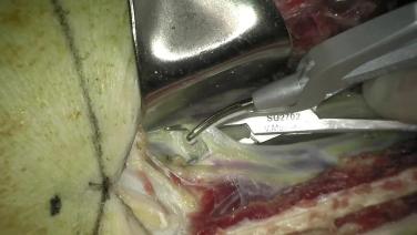 An Image of "Fibula Flap Harvest Using HARMONIC FOCUS™+ Shears with Rod Rezaee, MD"
