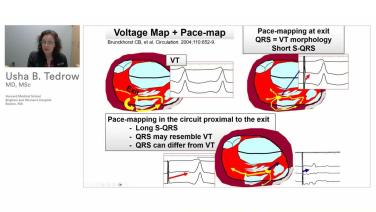 An Image From "Use of ECG and Entrainment to Identify Mechanism and Critical Sites for Catheter Ablation of Ventricular Arrhythmias with Usha Tedrow, MD"