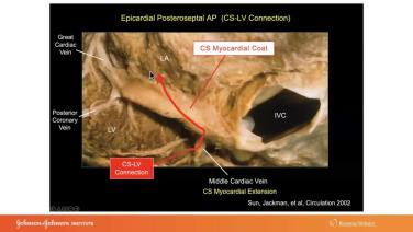 An Image From "A Simple Approach to Using the ECG to Localize Accessory Pathways with Warren "Sonny" Jackman, MD"