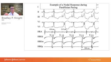An Image From "Step-by-Step Approach for Analyses of ECG and EGM Tracings to Differentiate Mechanisms of PSVT with Bradley Knight, MDv"