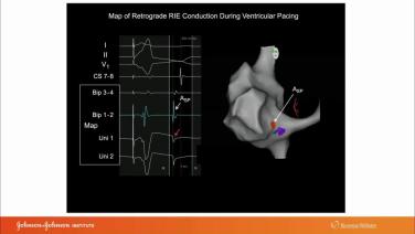 An Image From "Identifying the Antegrade and Retrograde Pathways in the Various Forms of AV Nodal Reentrant Tachycardia with Warren"Sonny" Jackman, MD"