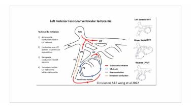 An IMage From "Fascicular VT with Melvin Scheinman, MD"