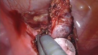 An Image From "Management of the Hiatal Hernia - Dr. Lipham"