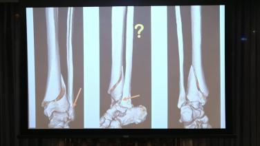 Complex Tibial Shaft Fractures Management