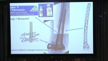 Tips and Tricks on Retrograde Nailing with Locking Attachment Washer System