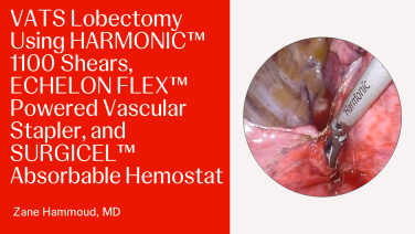 An image From "VATS Lobectomy Using HARMONIC™ 1100 Shears, ECHELON FLEX™ Powered Vascular Stapler, and SURGICEL™ Absorbable Hemostat"