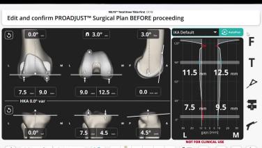 VELYS™ Robotic-Assisted Solution with Autoplan Software Review and Clinical Benefits of the Technology for Inverse 