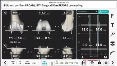 VELYS™Robotic-Assisted Solution with Autoplan Software Review and Clinical Benefits of the Technology for Inverse Kinematic Approach with Ugo Ihekweazu, MD