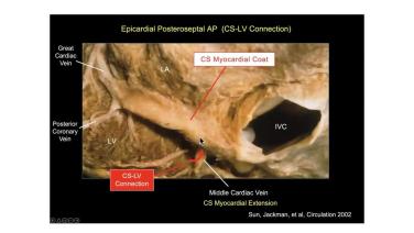An Image From "A Simple Approach to Using the ECG to Localize Accessory Pathways with Warren "Sonny" Jackman, MD"