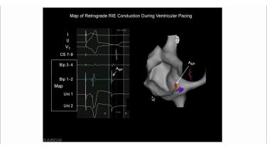 An Image From "Identifying the Antegrade and Retrograde Pathways in the Various Forms of AV Nodal Reentrant Tachycardia with Warren"Sonny" Jackman, MD"