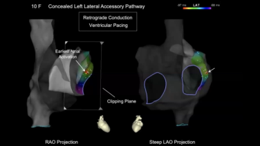 3D mapping during a complex SVT