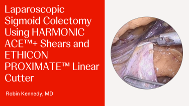 An Image From "Laparoscopic Sigmoid Colectomy Using HARMONIC ACE™+ Shears and ETHICON PROXIMATE™ Linear Cutter with Robin Kennedy, MD"