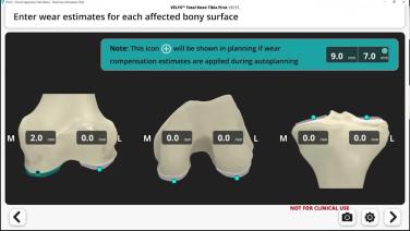 VELYS™Robotic-Assisted Solution with Autoplan Software Review and Clinical Benefits of the Technology for Kinematically Balanced Approach with Colin Mudrick, MD