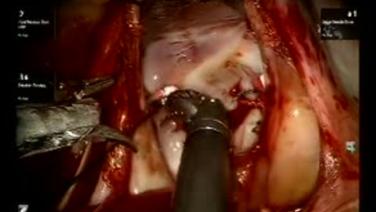 Mitral Valve Repair (MVR) - Knot tying of Annuloplasty Sutures