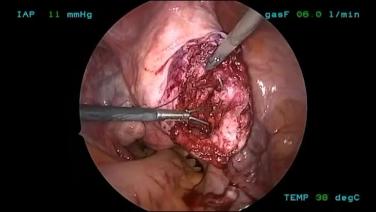 An image of the "Myomectomy Using HARMONIC ACE+7 Shears and STRATAFIX™ Symmetric PDS™ Plus Knotless Tissue Control Device with James Kondrup, MD" video on the JnJInstitute.com website.