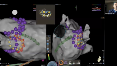Dr Krishnan discusses AF workflow with the VARIPULSE Catheter