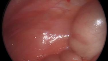 Laparoscopic Low Anterior Resection - Closure