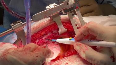 Coronary Artery Bypass Grafting (CABG) - Harvesting of the Left Internal Mammary Artery (LIMA)
