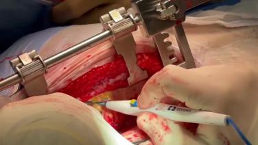 Coronary Artery Bypass Grafting (CABG) - Dissection of the Left Internal Mammary Artery (LIMA)