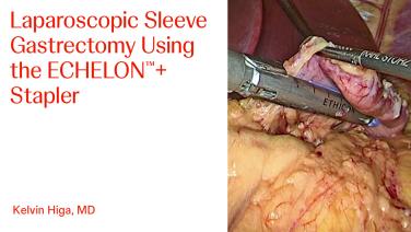 An image from "Laproscopic Sleeve Gastrectomy with ECHELON™+"