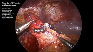 An Image From "Hiatal Hernia Repair and LINX™ Placement with John Lipham, MD"