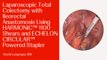 Laparoscopic Total Colectomy with Ileorectal Anastomosis Using HARMONIC™ 1100 Shears and ECHELON CIRCULAR™ Powered Stapler