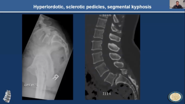 MIS Approach - TLIF Case Study with Todd Allen MD, PhD