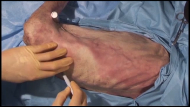An Image From "Posterolateral Thoracotomy for Rib Fixation - William Long, MD and Steve Madey, MD"
