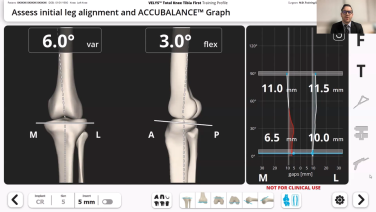 Image from VELYS Robotic-Assisted Solution Case Walkthough with Dr. Timothy Alton
