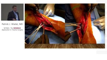 image from Continuous Compression Implants: General Trauma Applications with Patrick Wiater, MD