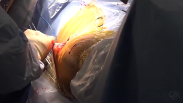Image from Anterior Advantage MATTA METHOD Acetabulum Cup Insertion - David DeCook MD