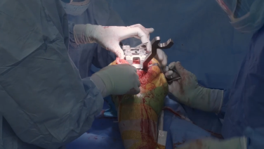 Image from ATTUNE™ Revision Knee System: Live Surgical Procedure with Tibial and Femoral Sleeves with Wayne Moschetti, MD