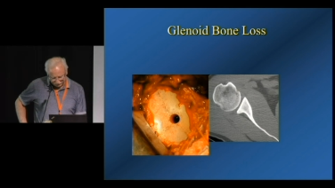 Image from Dealing with Glenoid Bone Loss - Carl Basamania, MD
