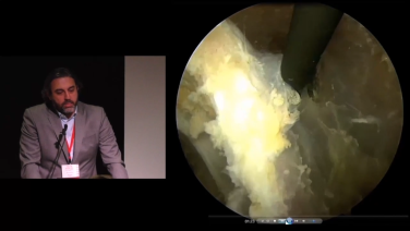 Arthroscopic Latarjet Procedure in progress