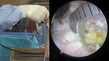 iamge from ACL Reconstruction: Tunnel Drilling Utilizing TWISTR Retrograde Reamer & Cruciate+ Instruments with Amir Moinfar, MD